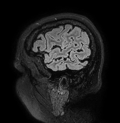 Cerebral arteriovenous malformation (Radiopaedia 74411-85654 Sagittal FLAIR 13).jpg