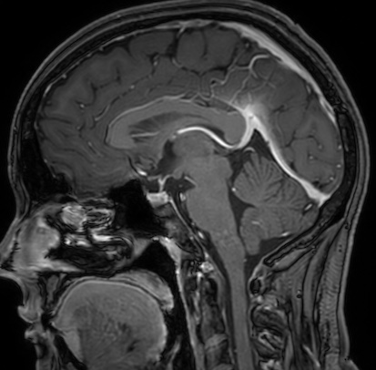 Cerebral arteriovenous malformation (Radiopaedia 74411-85654 Sagittal T1 C+ 66).jpg