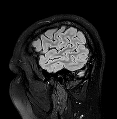 Cerebral arteriovenous malformation (Radiopaedia 74411-85746 Sagittal FLAIR 11).jpg