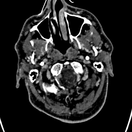 Cerebral arteriovenous malformation (Radiopaedia 78188-90746 Axial C+ delayed 11).jpg