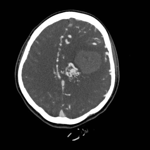File:Cerebral arteriovenous malformation (Radiopaedia 79677-92888 A 38).jpg