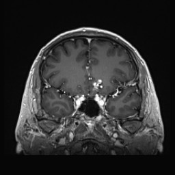 Cerebral arteriovenous malformation (Radiopaedia 84015-99245 Coronal T1 C+ 57).jpg