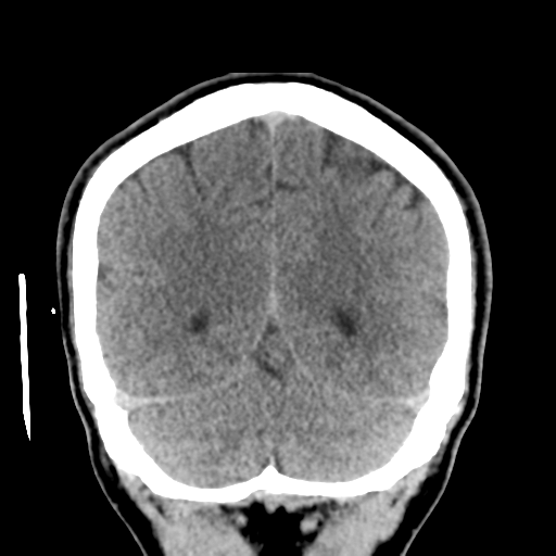 Cerebral arteriovenous malformation (Spetzler-Martin grade 2) (Radiopaedia 41262-44076 Coronal non-contrast 49).png