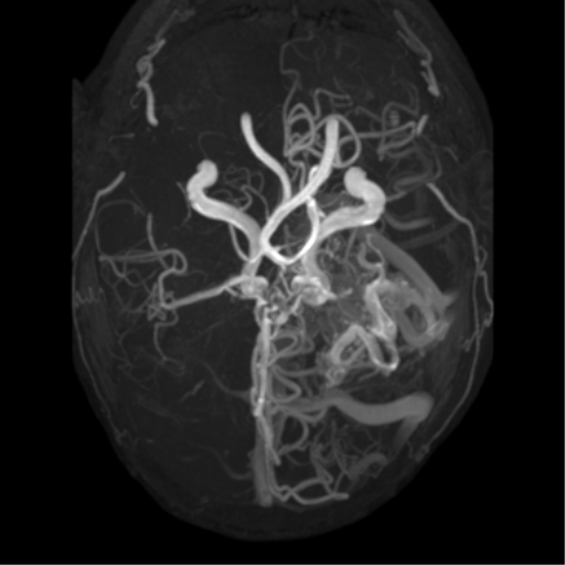 File:Cerebral arteriovenous malformation - huge (Radiopaedia 35734-37272 MRA 13).png