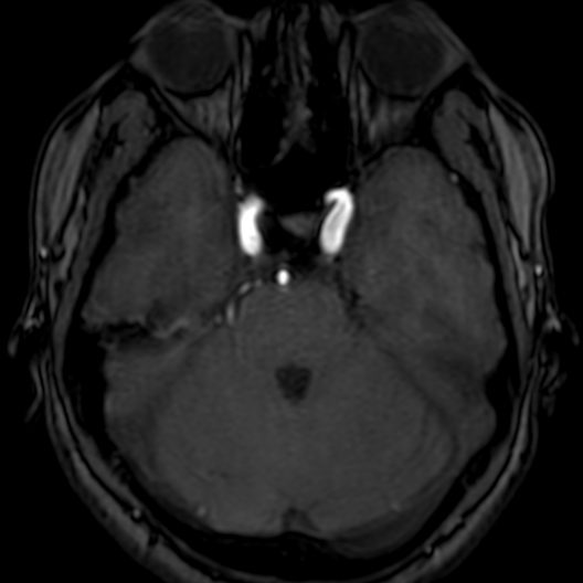 Cerebral arteriovenous malformation at posterior body of corpus callosum (Radiopaedia 74111-84925 Axial MRA 58).jpg