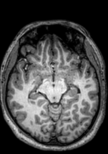 File:Cerebral arteriovenous malformation at posterior body of corpus callosum (Radiopaedia 74111-84925 Axial T1 177).jpg