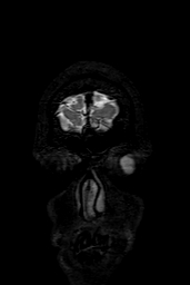 Cerebral arteriovenous malformation at posterior body of corpus callosum (Radiopaedia 74111-84925 Coronal T2 2).jpg