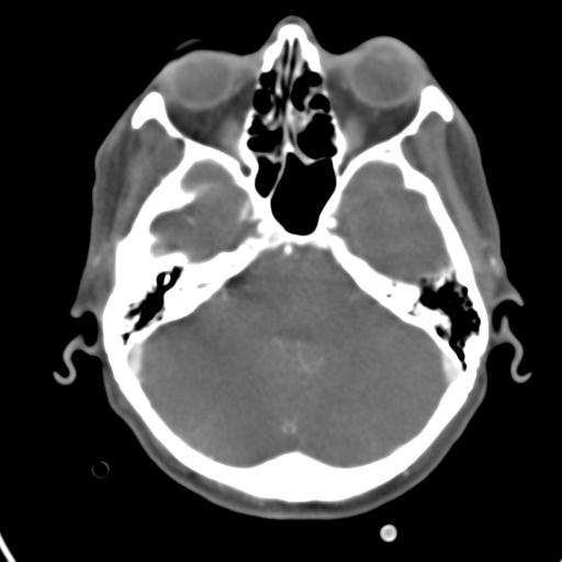 Cerebral arteriovenous malformation with hemorrhage (Radiopaedia 28773-29073 A 40).jpg