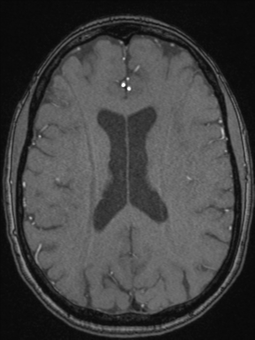 Cerebral arteriovenous malformation with hemorrhage (Radiopaedia 34422-35737 Axial MRA 51).png
