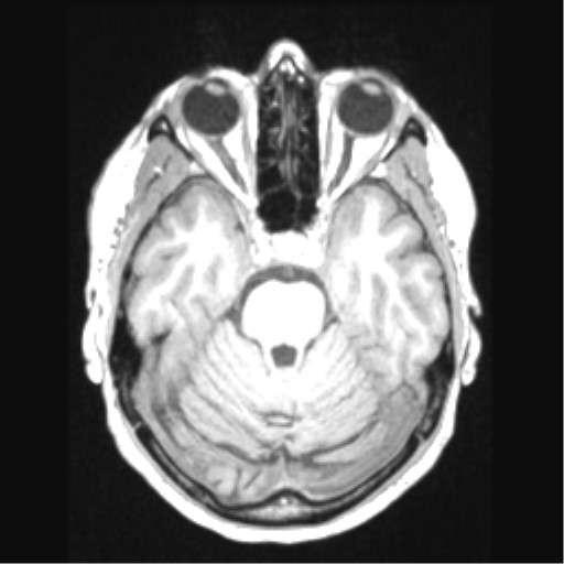 Cerebral arteriovenous malformation with hemorrhage (Radiopaedia 34422-35737 Axial T1 26).png