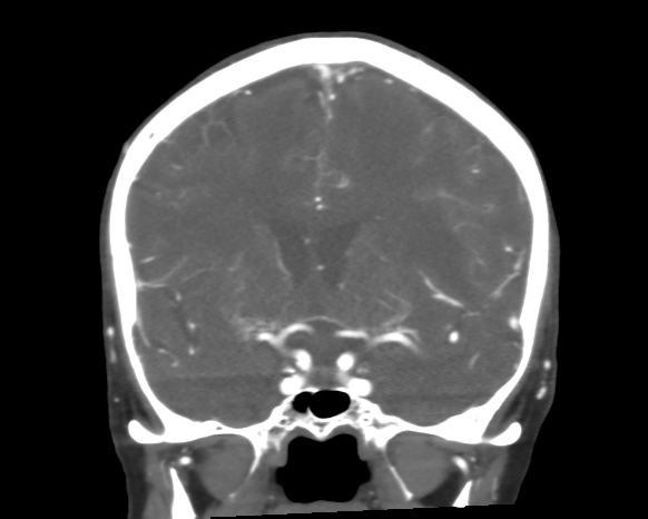 Cerebral arteriovenous malformation with lobar hemorrhage (Radiopaedia 44725-48511 A 26).png
