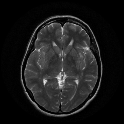 File:Cerebral autosomal dominant arteriopathy with subcortical infarcts and leukoencephalopathy (CADASIL) (Radiopaedia 41018-43768 Ax T2 PROP 10).png