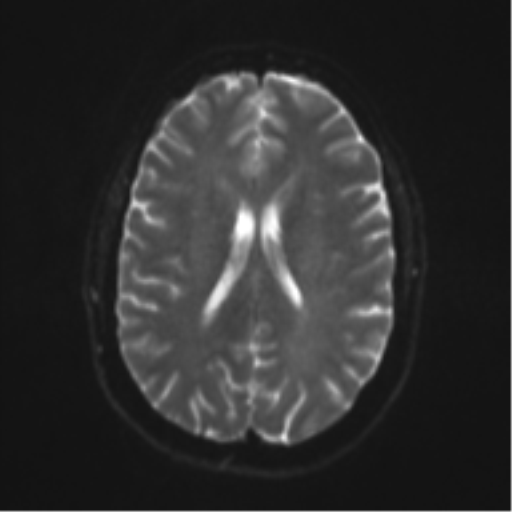 File:Cerebral cavernoma and development venous anomaly (Radiopaedia 37603-39482 Axial DWI 14).png