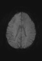 File:Cerebral cavernoma and development venous anomaly (Radiopaedia 37603-39482 Axial SWI MIP 24).png