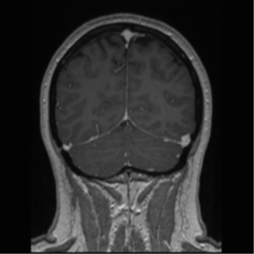 Cerebral cavernoma and development venous anomaly (Radiopaedia 37603-39482 Coronal T1 C+ 24).png