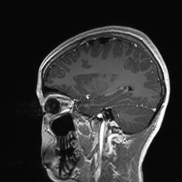 Cerebral cavernous venous malformation (Radiopaedia 70008-80021 Sagittal T1 C+ 22).jpg