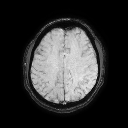 Cerebral cavernous venous malformation (Zabramski type II) (Radiopaedia 85511-101198 Axial SWI 85).jpg