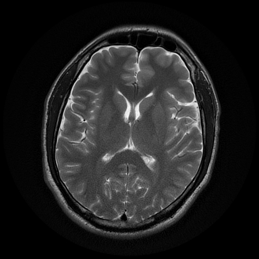 File:Cerebral cavernous venous malformation (Zabramski type II) (Radiopaedia 85511-101198 Axial T2 18).jpg