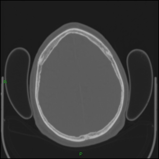 Cerebral contusions (Radiopaedia 33868-35039 Axial bone window 163).jpg