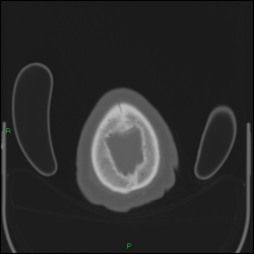 Cerebral contusions (Radiopaedia 33868-35039 Axial bone window 215).jpg