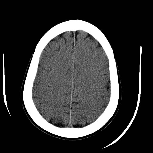 File:Cerebral edema (evolution in time) (Radiopaedia 19418-19440 non-contrast 72).jpg