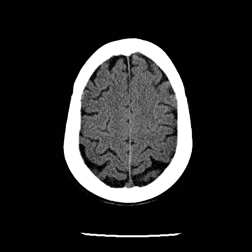 Cerebral edema (evolution in time) (Radiopaedia 19418-19441 non-contrast 75).jpg