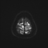 Cerebral embolic infarcts (embolic shower) (Radiopaedia 72391-82921 Axial DWI 58).jpg