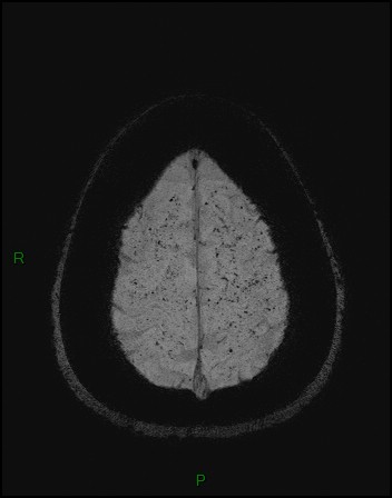 Cerebral fat embolism (Radiopaedia 35022-36525 Axial SWI 55).jpg