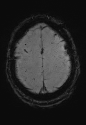 File:Cerebral hemorrhagic contusions- temporal evolution (Radiopaedia 40224-42757 D 33).png