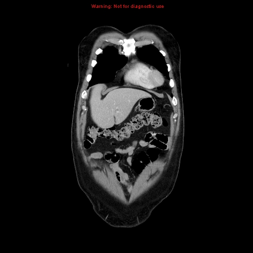 File:Cerebral metastasis - colorectal carcinoma (Radiopaedia 8581-83548 A 17).jpg