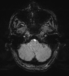 Cerebral metastasis - melanoma (Radiopaedia 54718-60954 Axial SWI 8).png