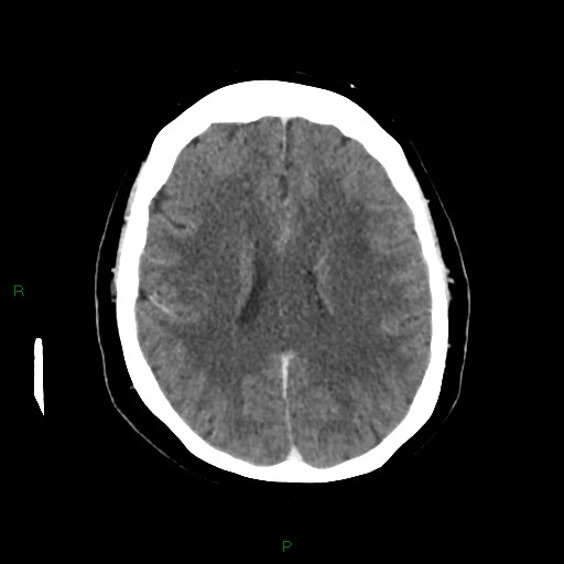 File:Cerebral metastasis from renal cell carcinoma (Radiopaedia 82306-96375 Axial C+ delayed 24).jpg