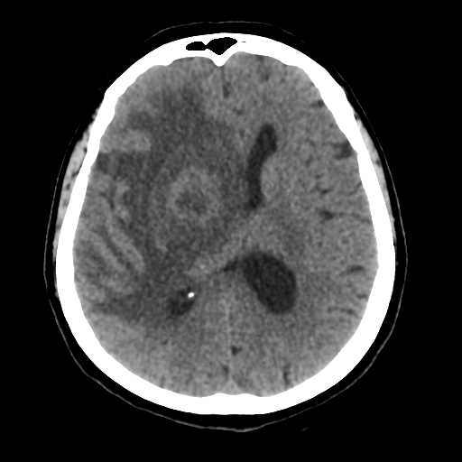 File:Cerebral metastasis to basal ganglia (Radiopaedia 81568-95412 Axial non-contrast 36).png