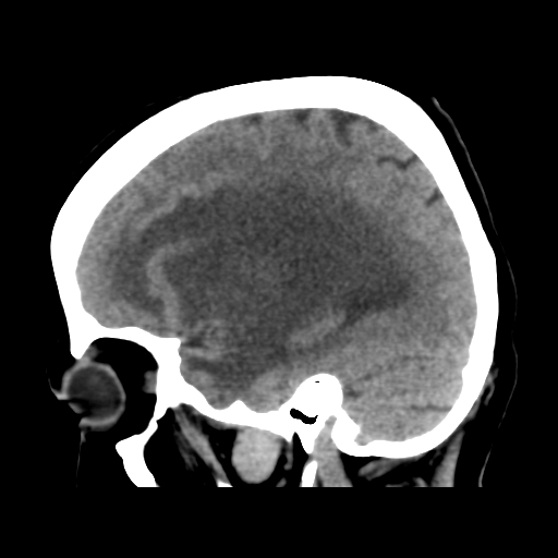 Cerebral metastasis to basal ganglia (Radiopaedia 81568-95412 E 20).png