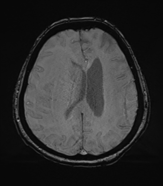 Cerebral metastasis to basal ganglia (Radiopaedia 81568-95413 Axial SWI 57).png
