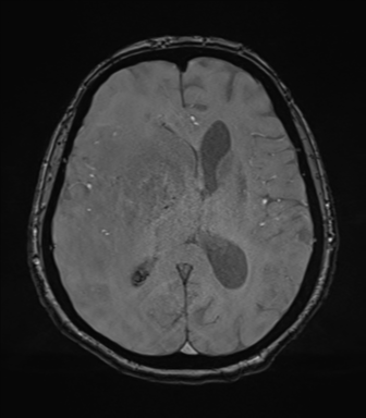 File:Cerebral metastasis to basal ganglia (Radiopaedia 81568-95413 Axial SWI magnitude 48).png