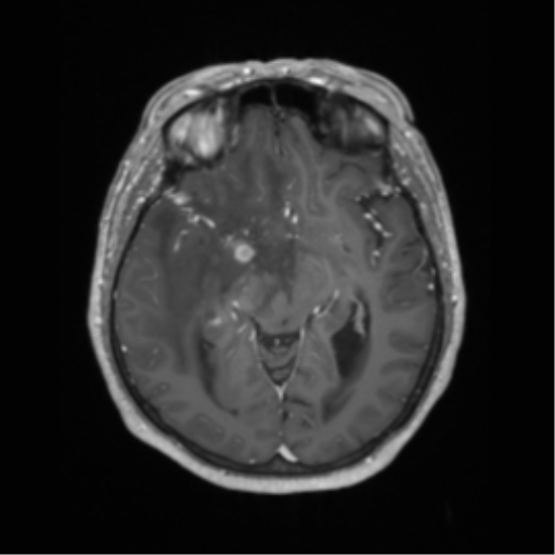 Cerebral metastasis to basal ganglia (Radiopaedia 81568-95413 Axial T1 C+ 31).png