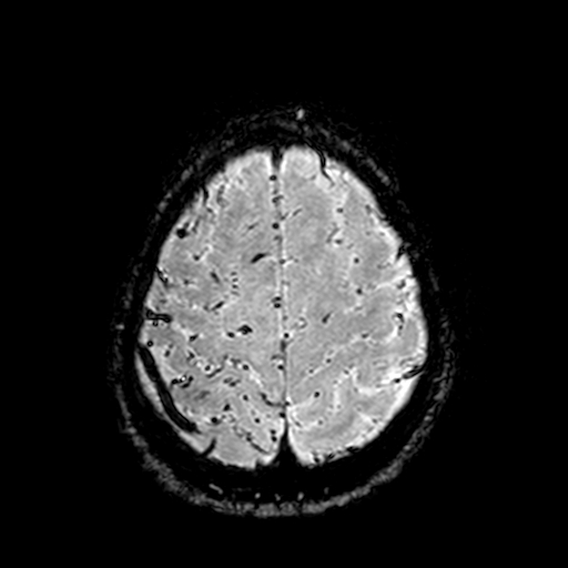 Cerebral parenchymal arteriovenous malformation (Radiopaedia 27280-27456 Axial SWI 105).jpg