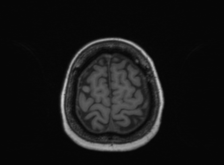 Cerebral ring enhancing lesions - cerebral metastases (Radiopaedia 44922-48817 Axial T1 125).jpg