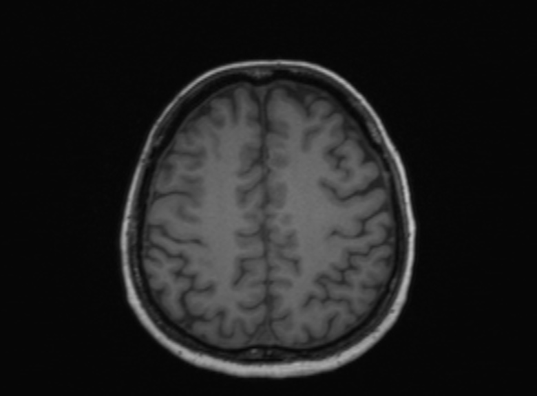 Cerebral ring enhancing lesions - cerebral metastases (Radiopaedia 44922-48817 Axial T1 164).jpg