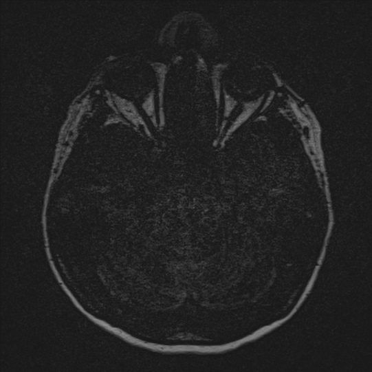 Cerebral ring enhancing lesions - cerebral metastases (Radiopaedia 44922-48817 F 2).jpg