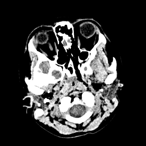 Cerebral tuberculosis with dural sinus invasion (Radiopaedia 60353-68018 Axial non-contrast 3).jpg