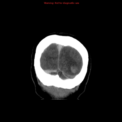 Cerebral venous infarction (Radiopaedia 12404-20735 B 77).jpg