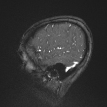 Cerebral venous infarction - hemorrhagic (Radiopaedia 81625-95505 Sagittal MRV 66).jpg