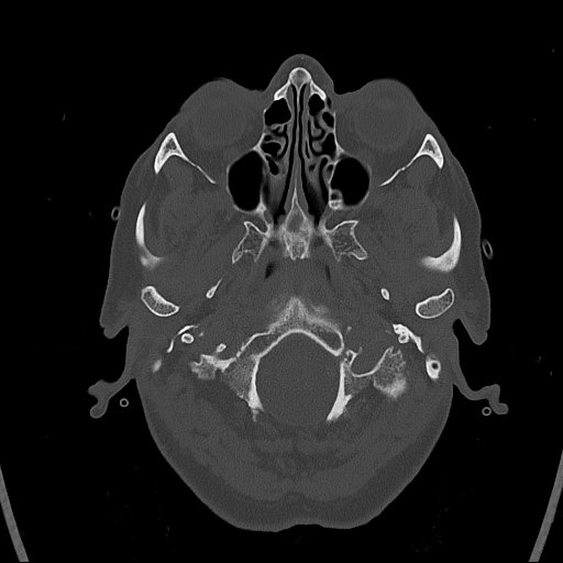 Cerebral venous infarction with hemorrhage (Radiopaedia 65343-74381 Axial bone window 4).jpg