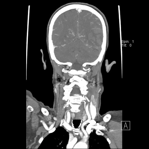 Cerebral venous infarction with hemorrhage (Radiopaedia 65343-74396 B 205).jpg