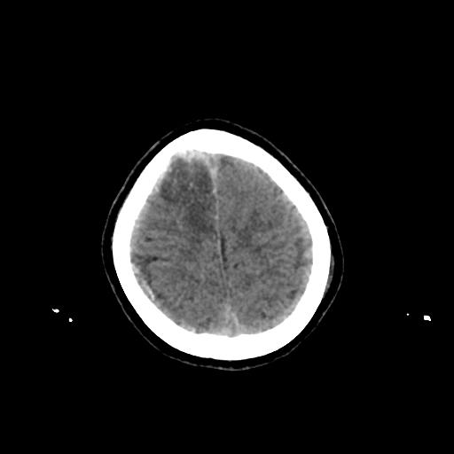 Cerebral venous throbmosis - hemorrhagic venous infarction (Radiopaedia 87318-103613 Axial non-contrast 150).jpg