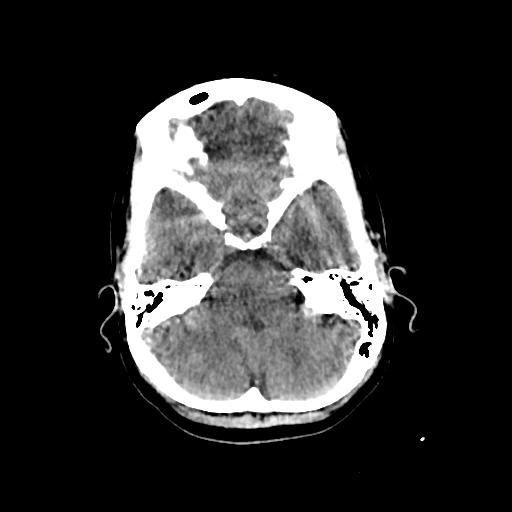Cerebral venous throbmosis - hemorrhagic venous infarction (Radiopaedia 87318-103613 Axial non-contrast 43).jpg