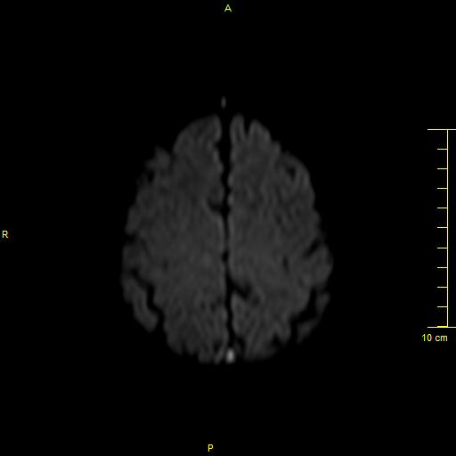 File:Cerebral venous thrombosis (Radiopaedia 23288-23351 Axial DWI 35).JPG