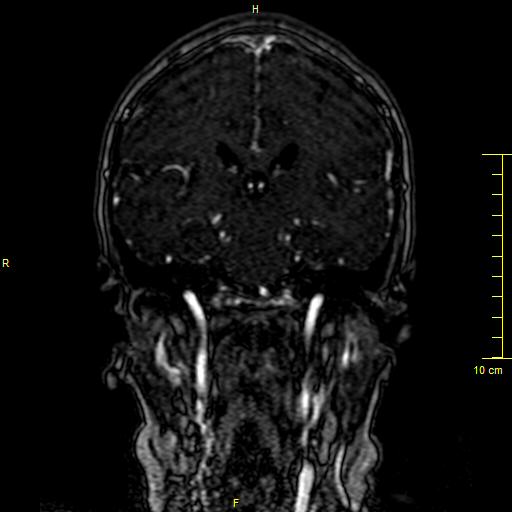 Cerebral venous thrombosis (Radiopaedia 23288-23351 MRV 86).JPG